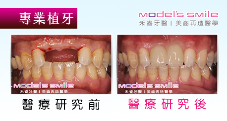 【台北牙醫人工植牙案例】前排門牙斷裂 3D雷射無痛植牙修補門面