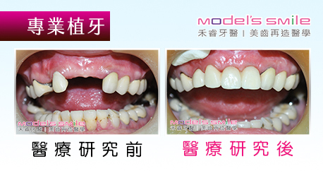 植牙 | 禾睿牙醫診所-呂睿庭醫師|台北人工植牙推薦,水波雷射牙周病,星鑽瓷牙貼片