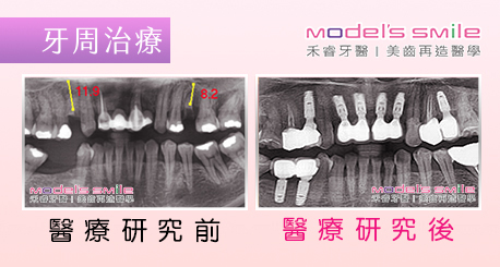 【台北牙醫 牙周治療+植牙案例】假牙裝戴不佳拖延就醫 導致牙周病缺牙更嚴重