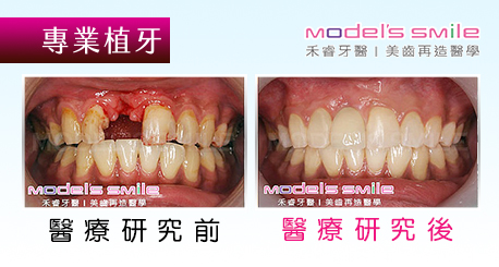 【台北牙醫複合式植牙案例】掉牙拖延 導致牙床骨萎縮 複合植牙一次到位