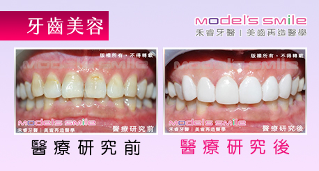 【台北牙醫星鑽超薄瓷牙貼片案例】專業、快速、安全療程 打造上班族完美齒型