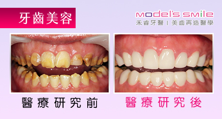 【台北牙醫星鑽超薄瓷牙貼片案例】貼片改善劣齒黃板牙 父女一同打造白淨微笑曲線