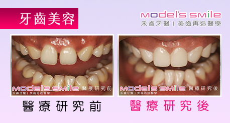 【台北牙醫 星鑽超薄瓷牙貼片案例】貼片改善黃牙齒型 提升櫃姐專業形象