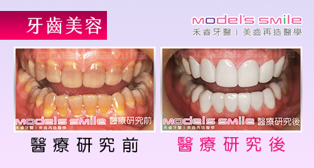 【台北牙醫 星鑽超薄瓷牙貼片案例】四環黴素影響衛生觀感 貼片拯救少女自信與生活