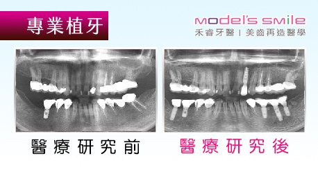 【台北牙醫 人工植牙案例】舒眠結合微創植牙 舒緩情緒快速重建口腔