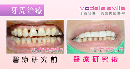 【台北牙醫 牙周治療案例】水波雷射零痛感 搭配貼片笑容整齊又健康