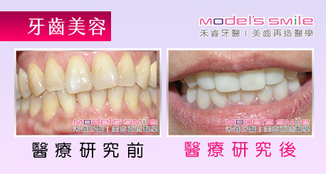【台北牙醫 星鑽超薄瓷牙貼片案例】汙垢影響衛生觀感 貼片美白迅速效果佳